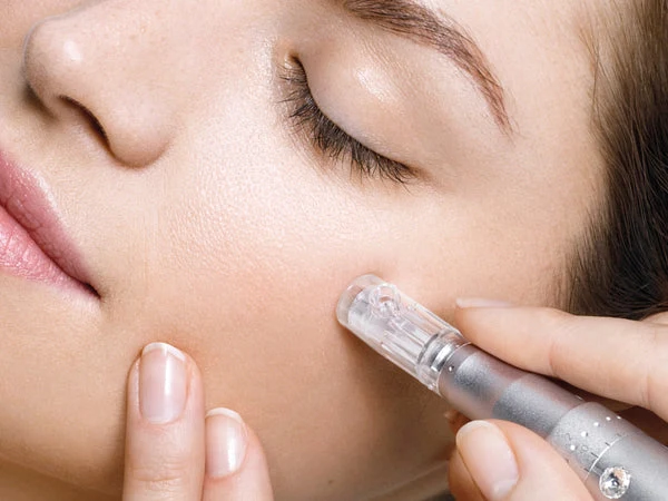 Microneedling offre de lancement